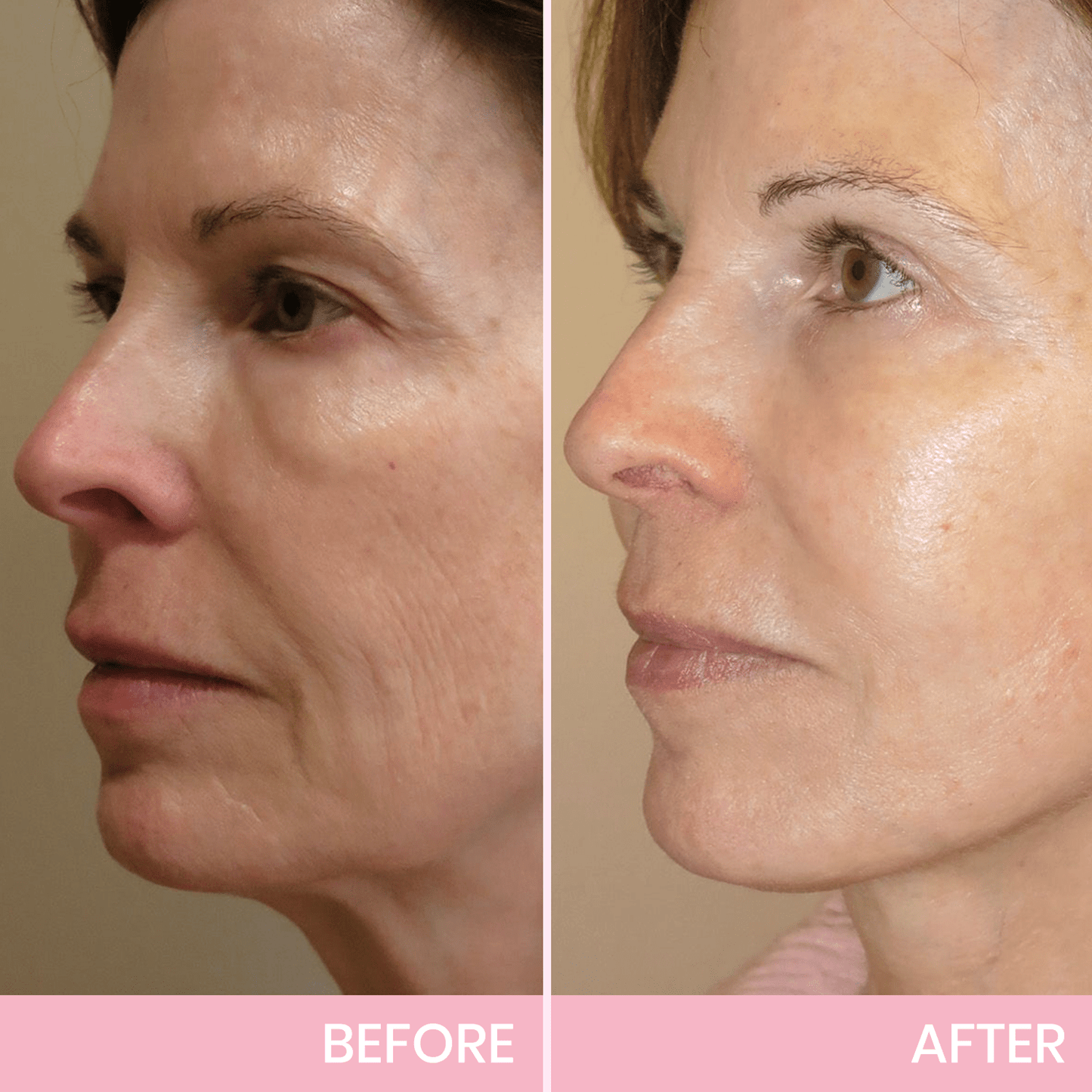 InvisiLift invisible face-lifting tape