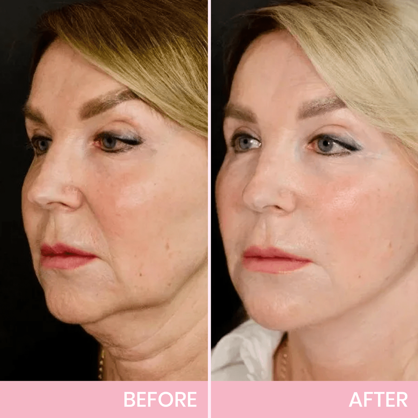 InvisiLift invisible face-lifting tape