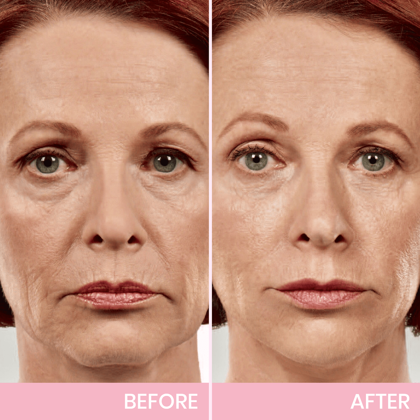 InvisiLift invisible face-lifting tape
