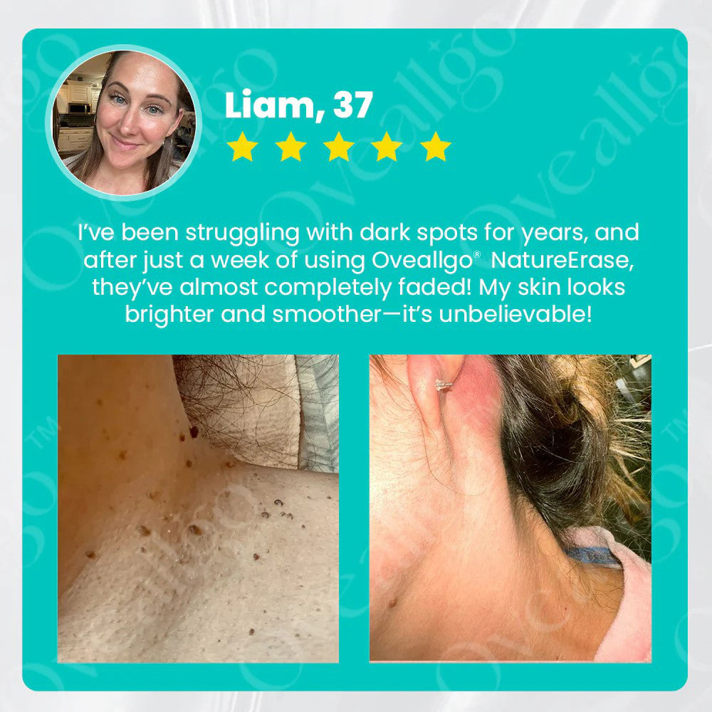 Applying NatureErase gel to targeted area on clean skin