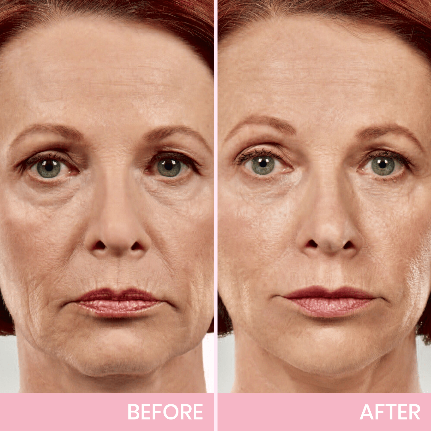 InvisiLift invisible face-lifting tape