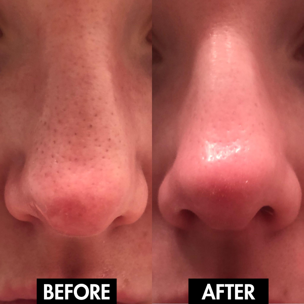 PoreLift Pro five replaceable suction heads for different skin needs