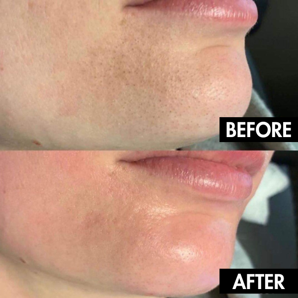 PoreLift Pro five replaceable suction heads for different skin needs